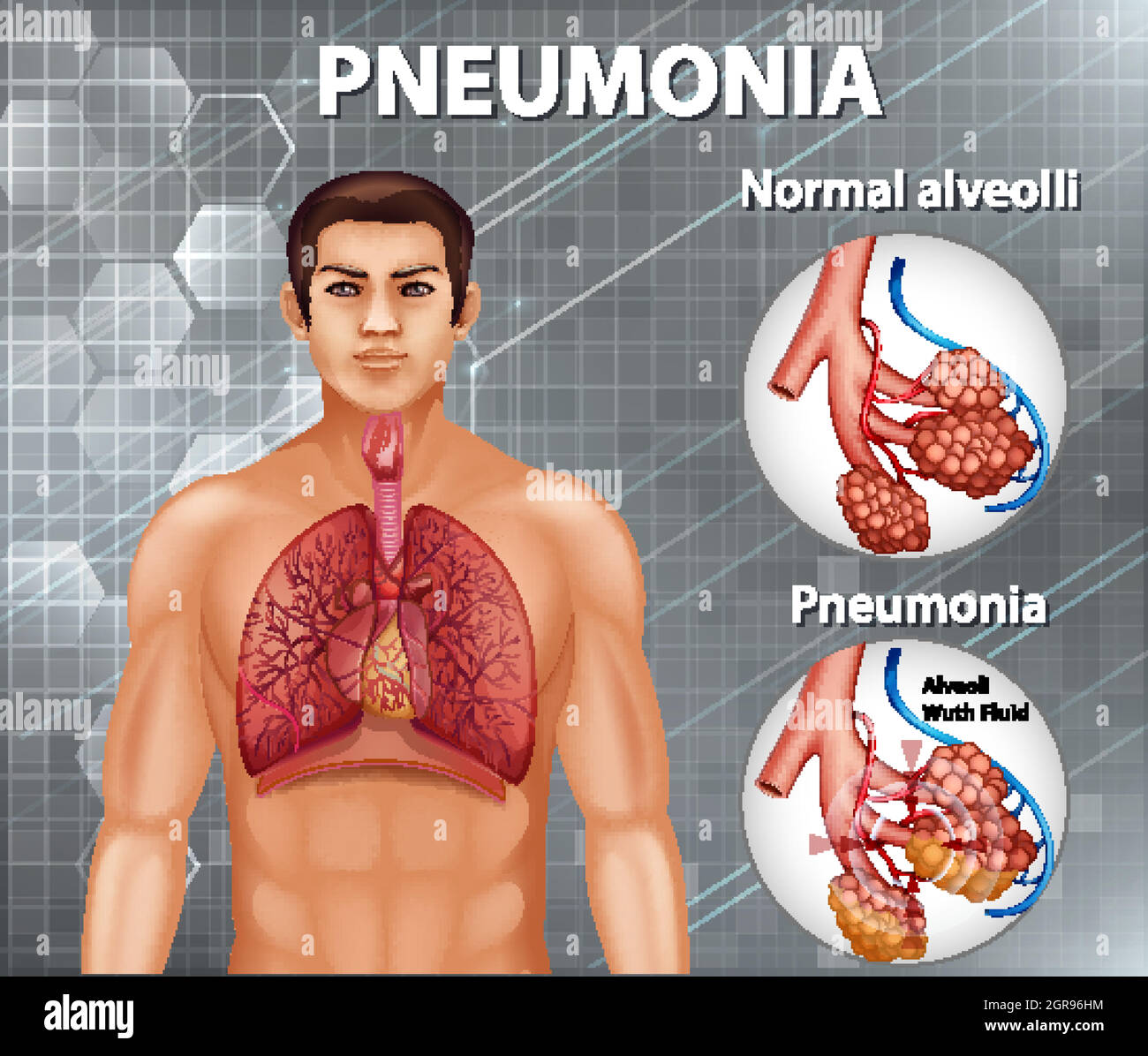 Comparaison d'alvéoles saines et de pneumonie Illustration de Vecteur