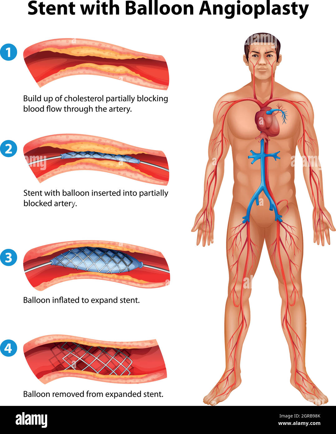 Procédure d'angioplastie du stent Illustration de Vecteur