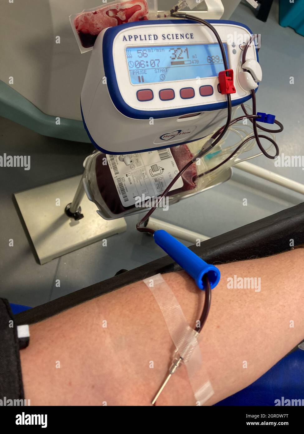 Un donneur de sang donne du sang dans un centre de don de sang NHS avec une aiguille dans le bras et du sang visible dans une tubulure en plastique.Centre des donneurs de sang du West End NHS. Banque D'Images