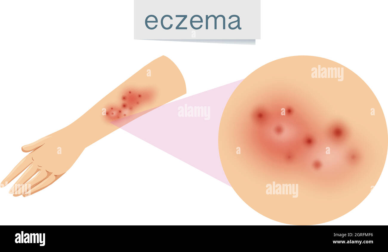 lupus skin disease banque d image et photos alamy