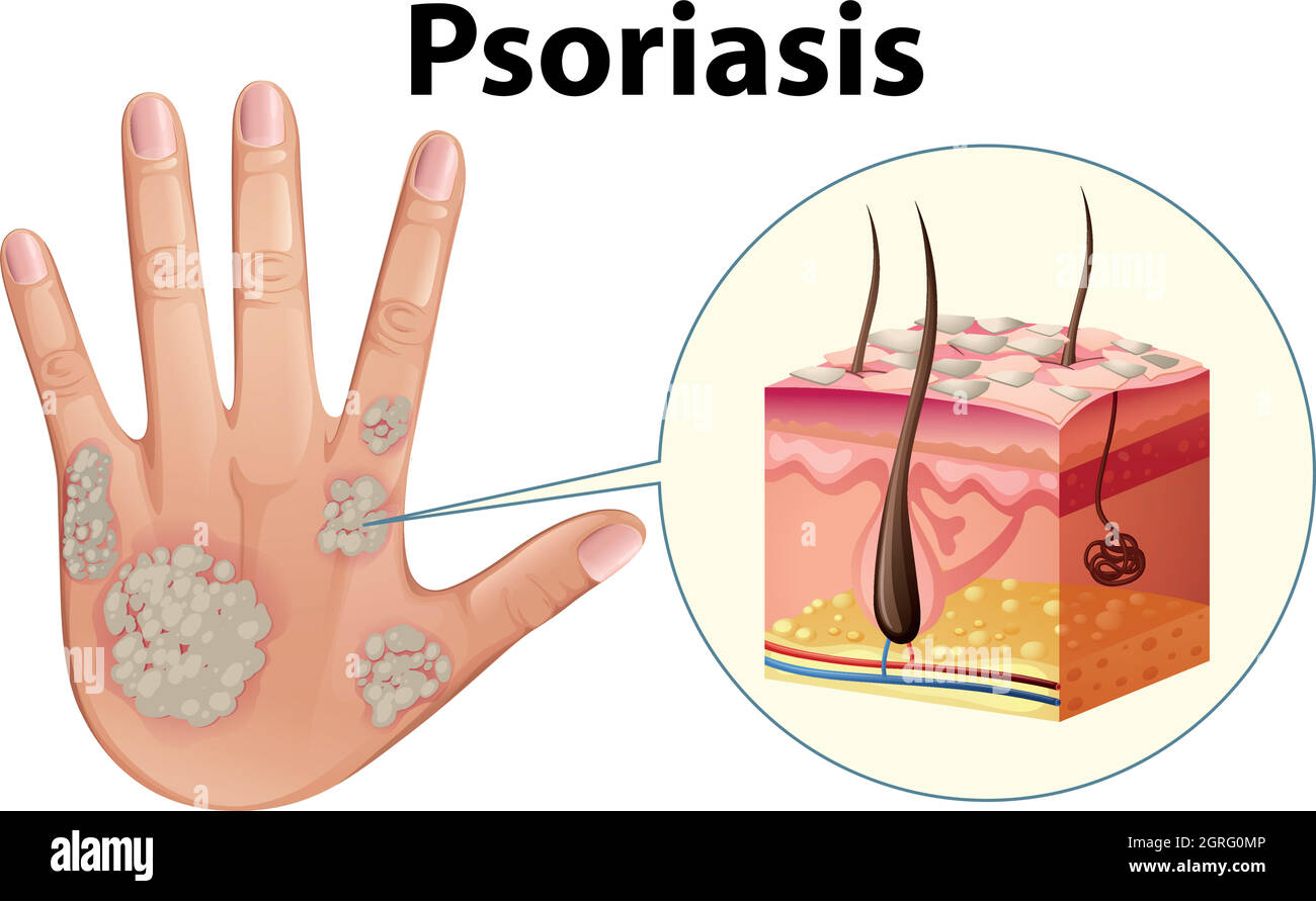 Schéma montrant le psoriasis de la main humaine Illustration de Vecteur