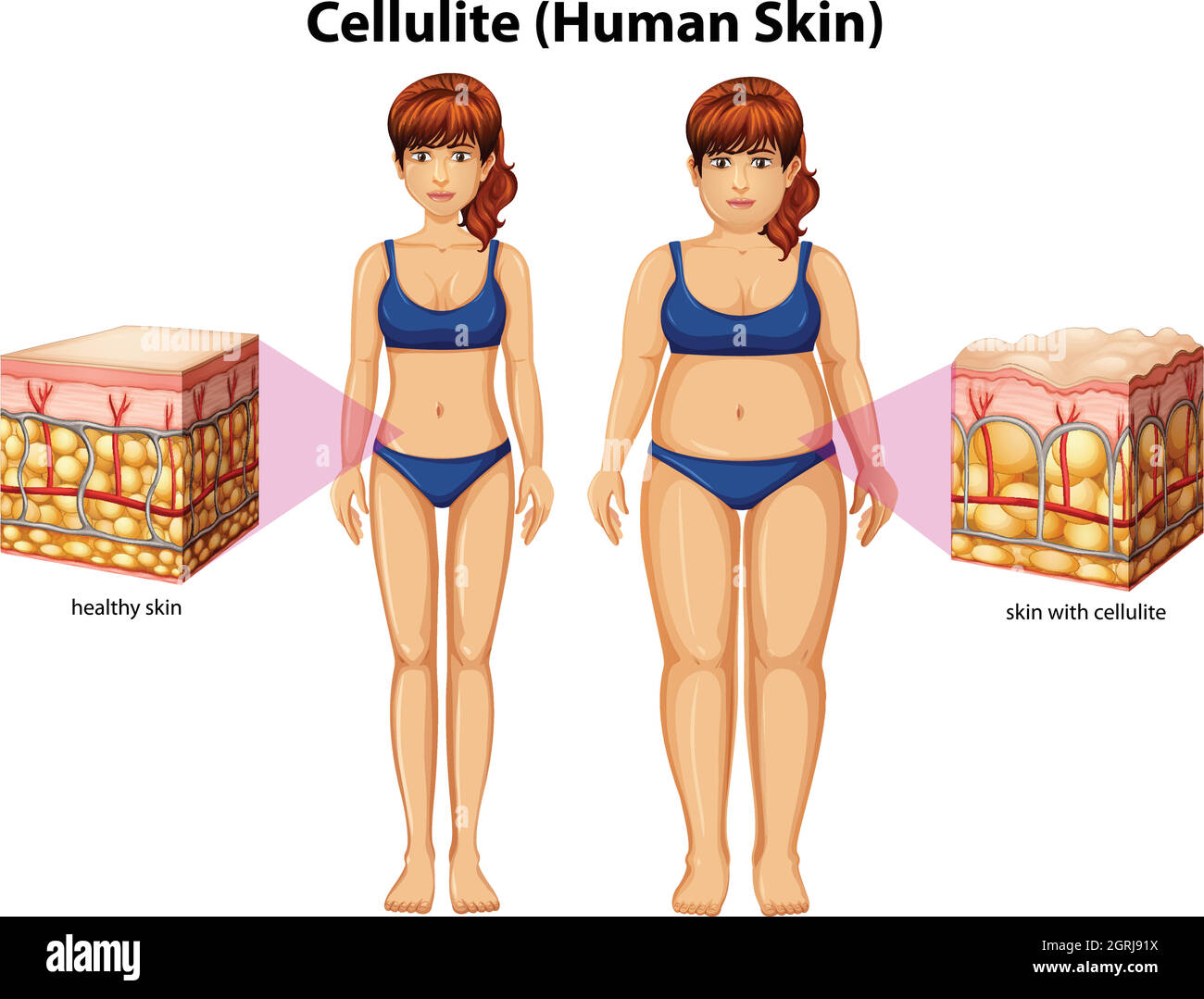 Une comparaison des femmes avec Cellulite Illustration de Vecteur