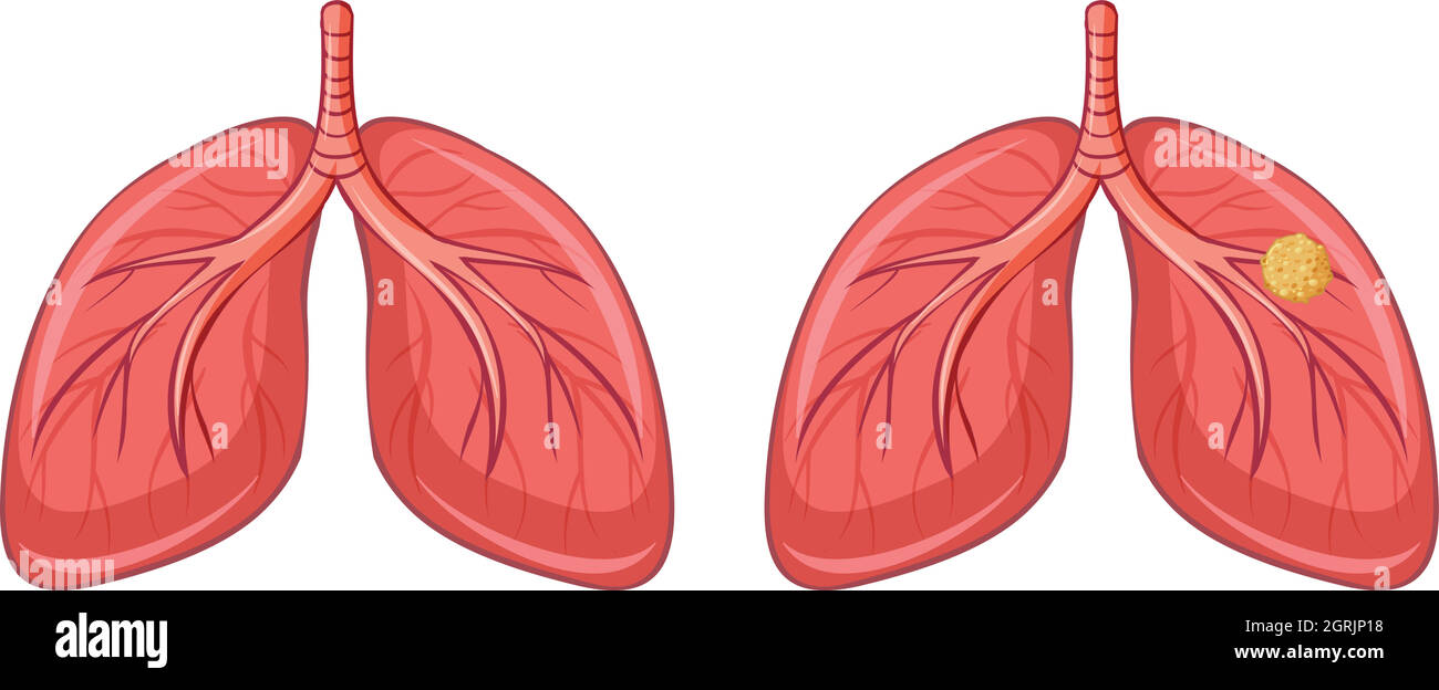 Poumons humains et cancer Illustration de Vecteur