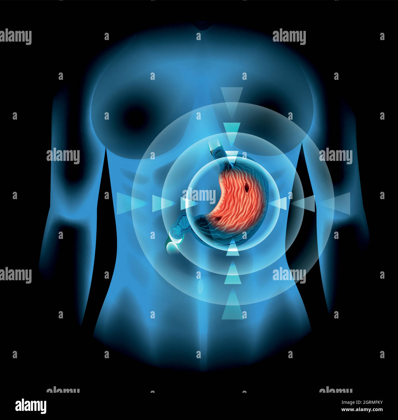Diagramme de l'ulcère de l'estomac chez la femme Illustration de Vecteur