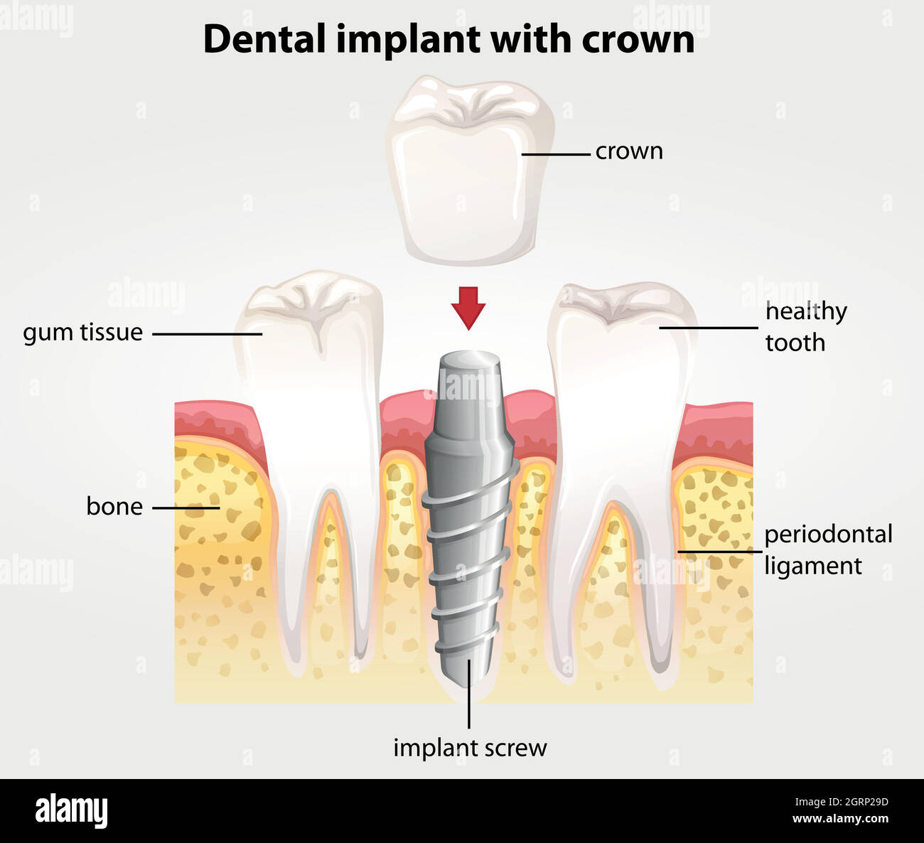 Implant dentaire avec couronne Illustration de Vecteur