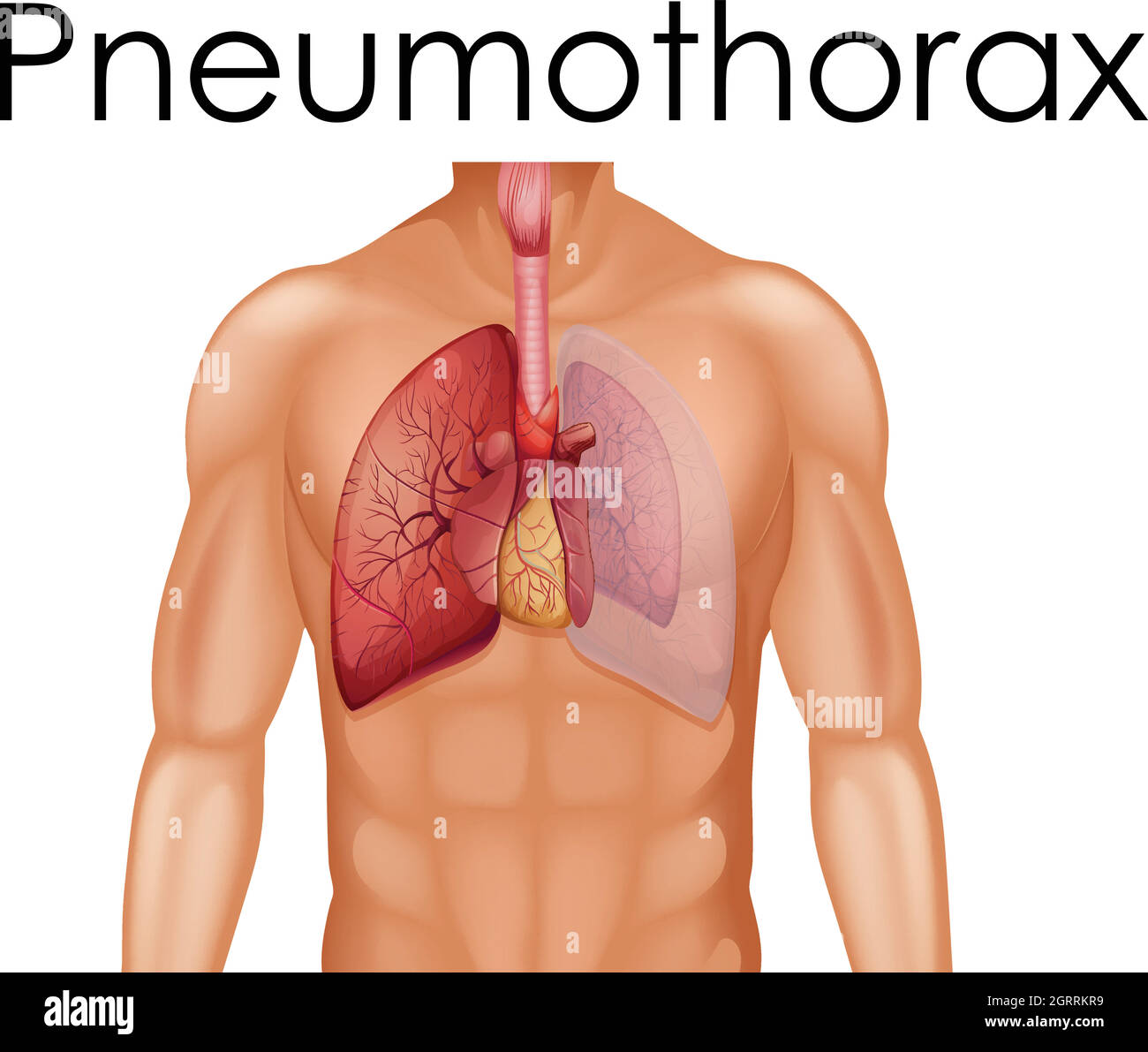 Anatomie humaine du pneumothorax Illustration de Vecteur