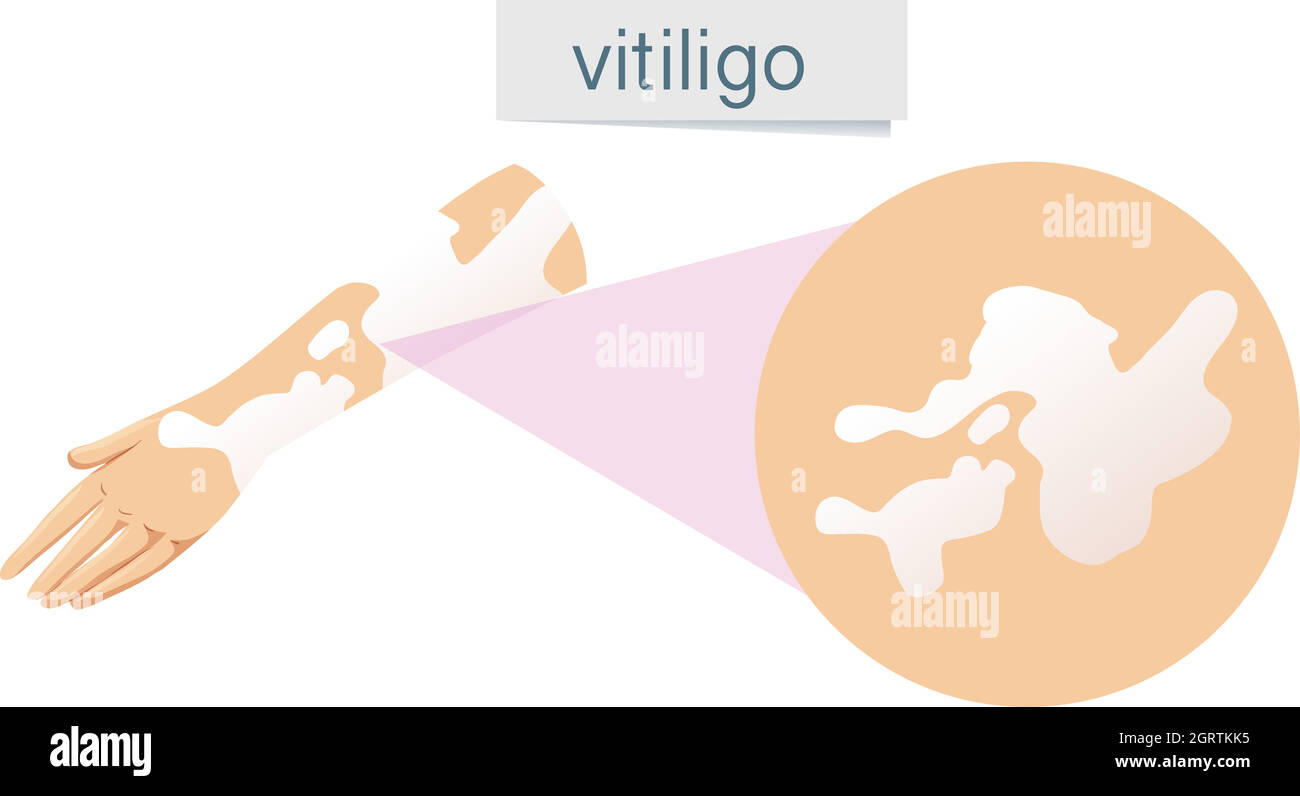 Un vecteur de Vitiligo sur la peau Illustration de Vecteur