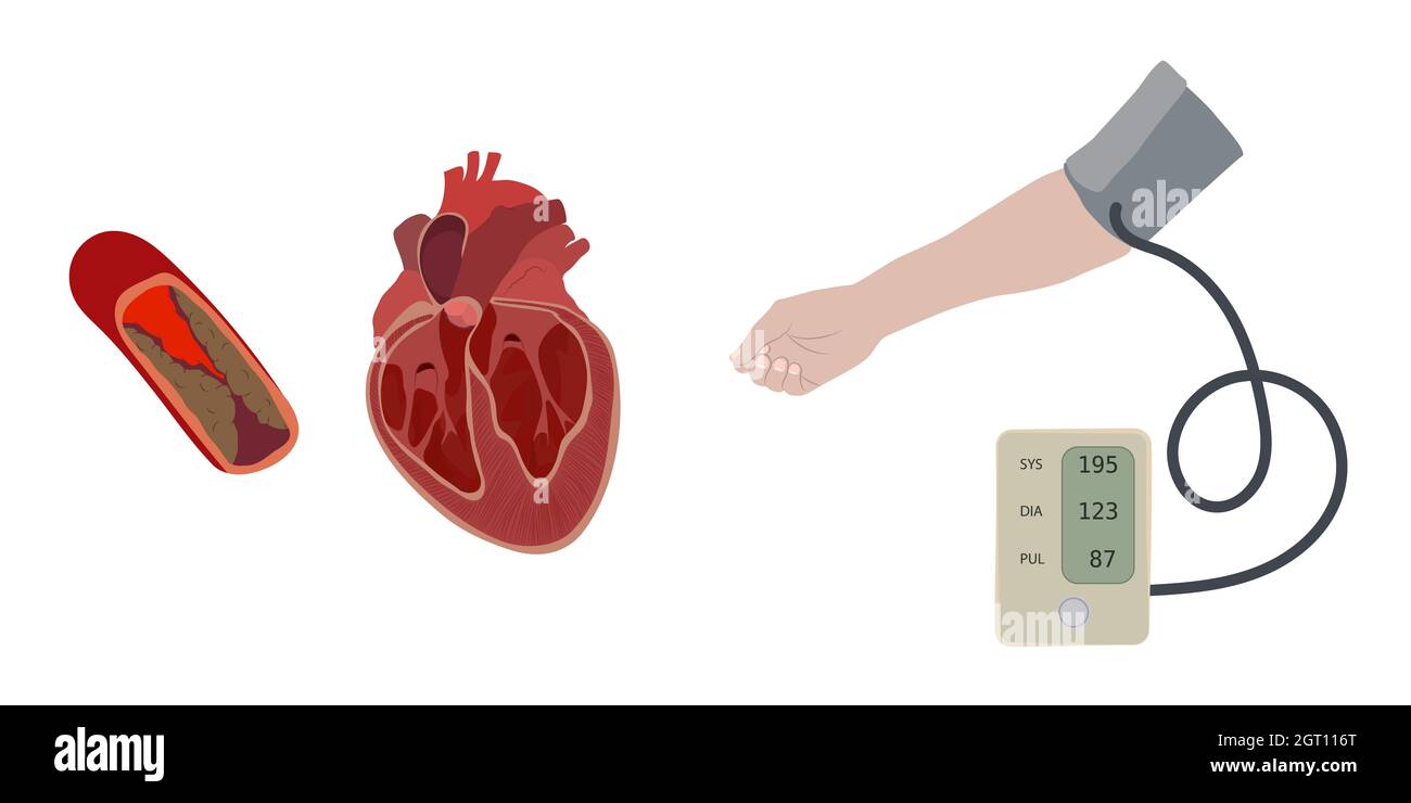 Cardiopathie hypertensive, illustration Banque D'Images