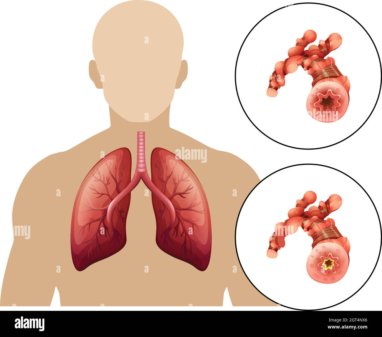 Maladie pulmonaire obstructive chronique humaine Illustration de Vecteur