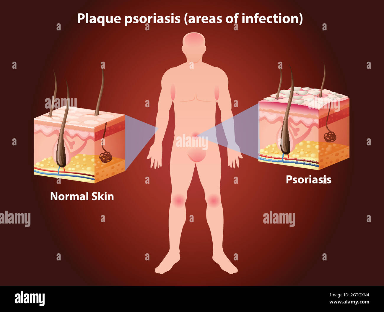 Schéma montrant le psoriasis en plaques chez l'homme Illustration de Vecteur