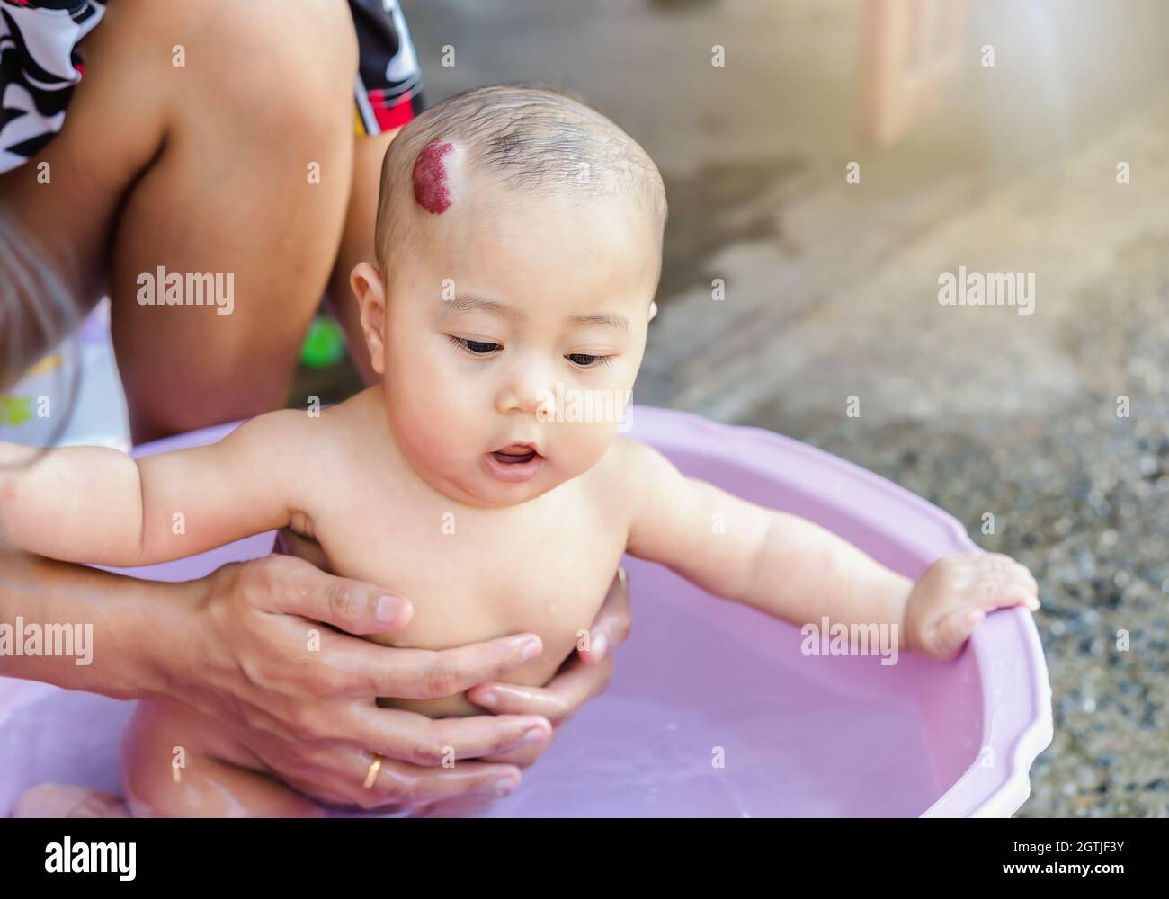 Tache De Naissance De Fraise Banque D Image Et Photos Alamy Tache De Naissance De Fraise Banque D Image Et Photos Alamy
