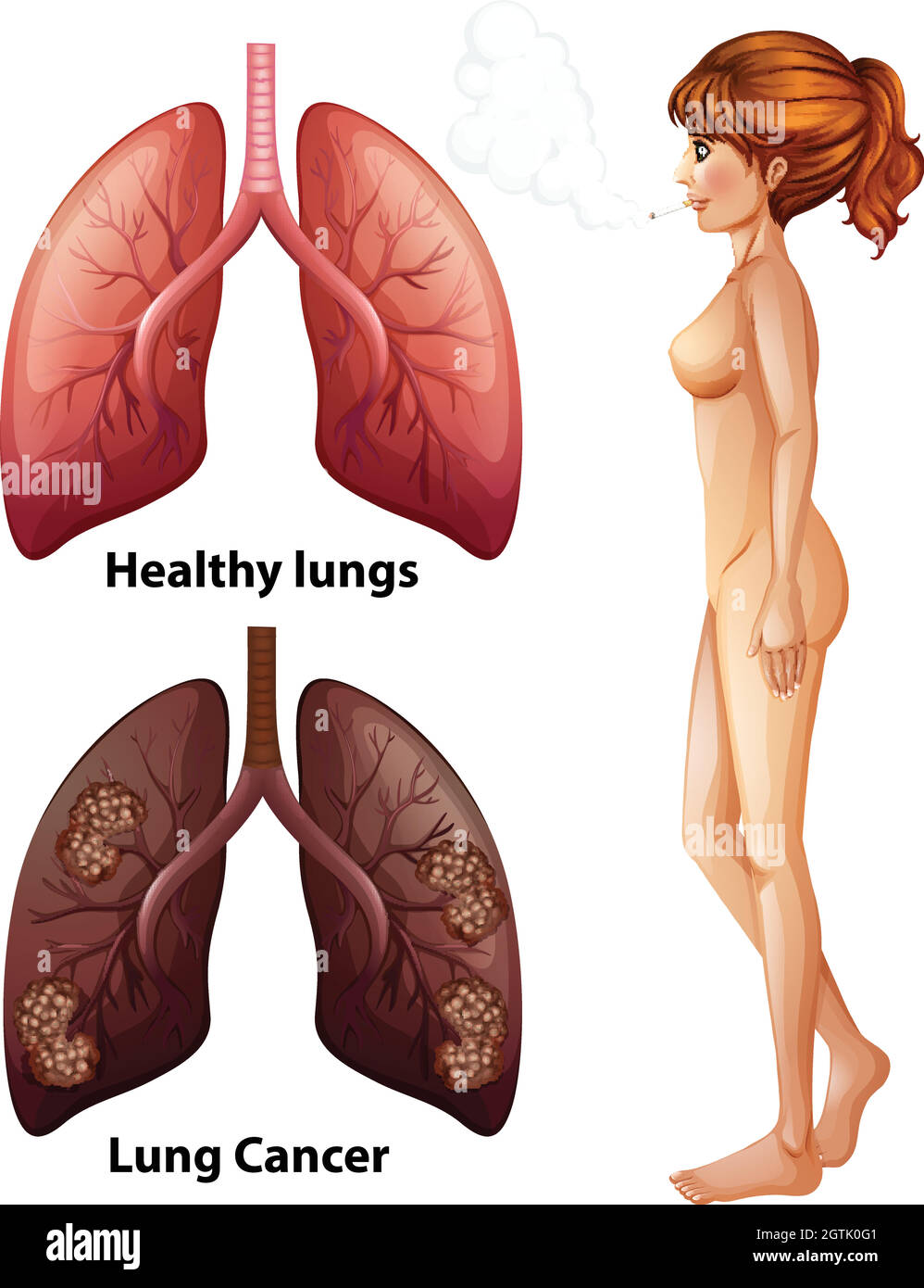 Anatomie humaine poumon de Smoker Illustration de Vecteur