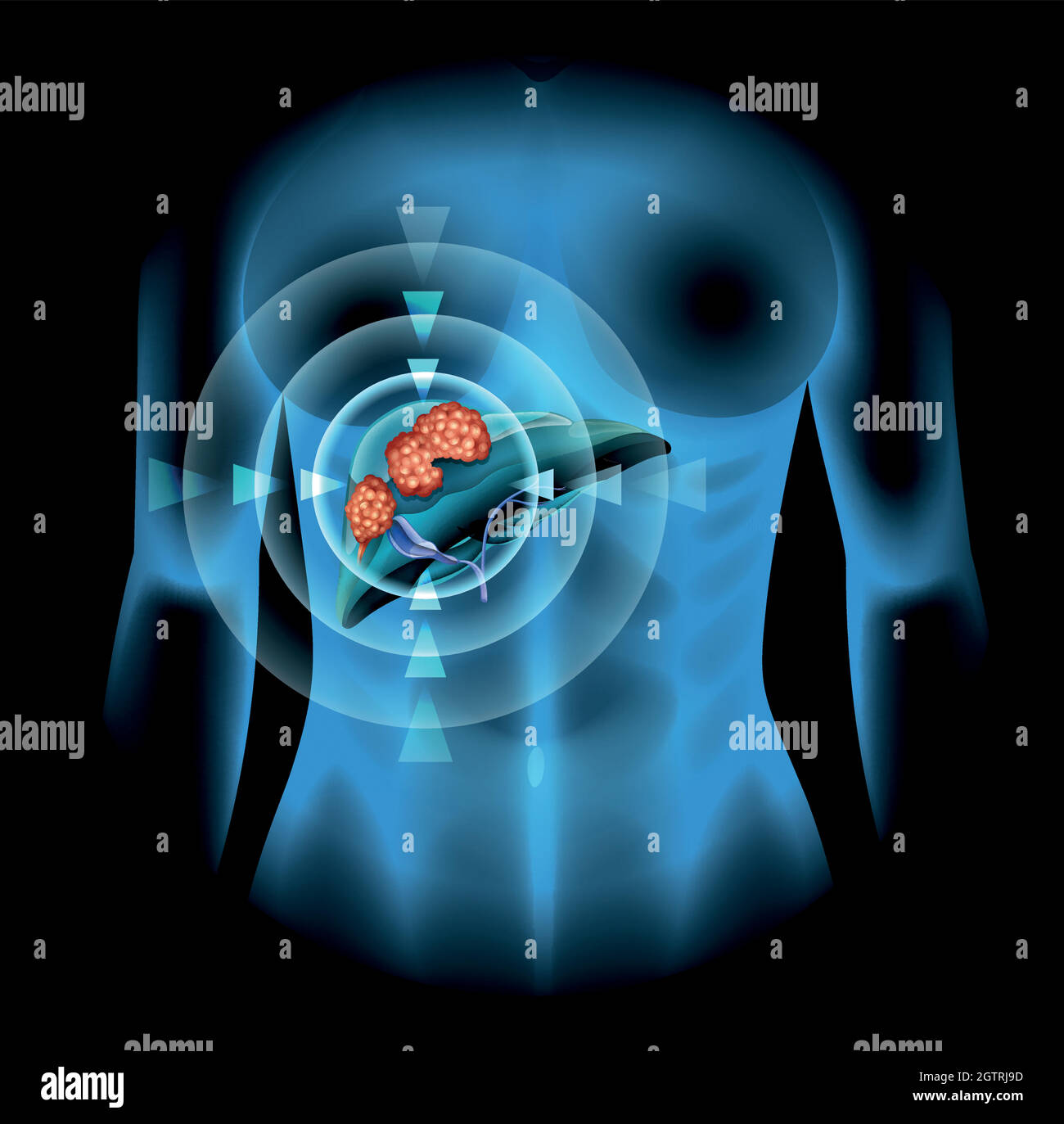 Diagramme de cancer du foie chez l'homme Illustration de Vecteur