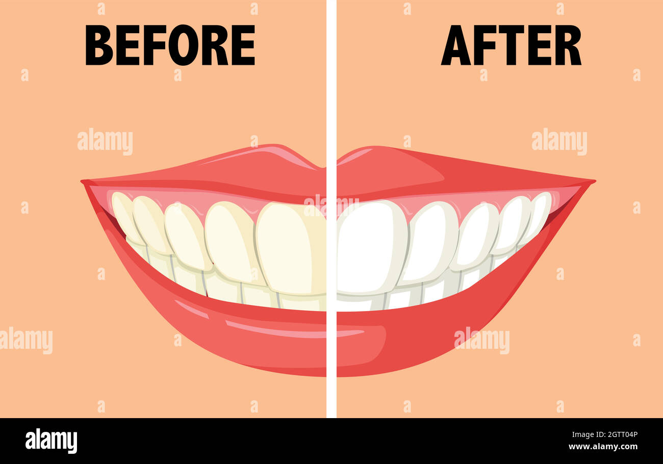 Avant et après le brossage des dents Illustration de Vecteur Avant et après le brossage des dents Illustration de Vecteur