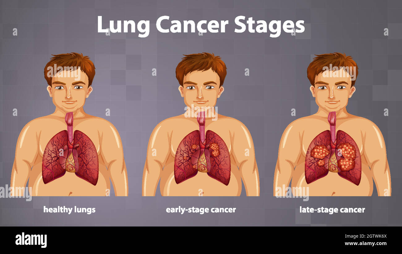 Illustration informative des stades du cancer du poumon Illustration de Vecteur