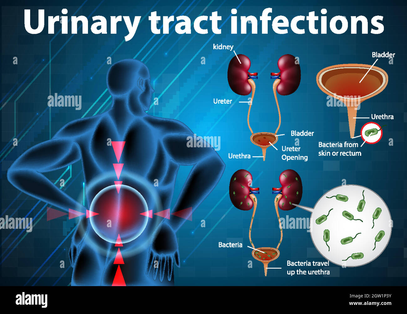 Illustration informative des infections des voies urinaires Illustration de Vecteur