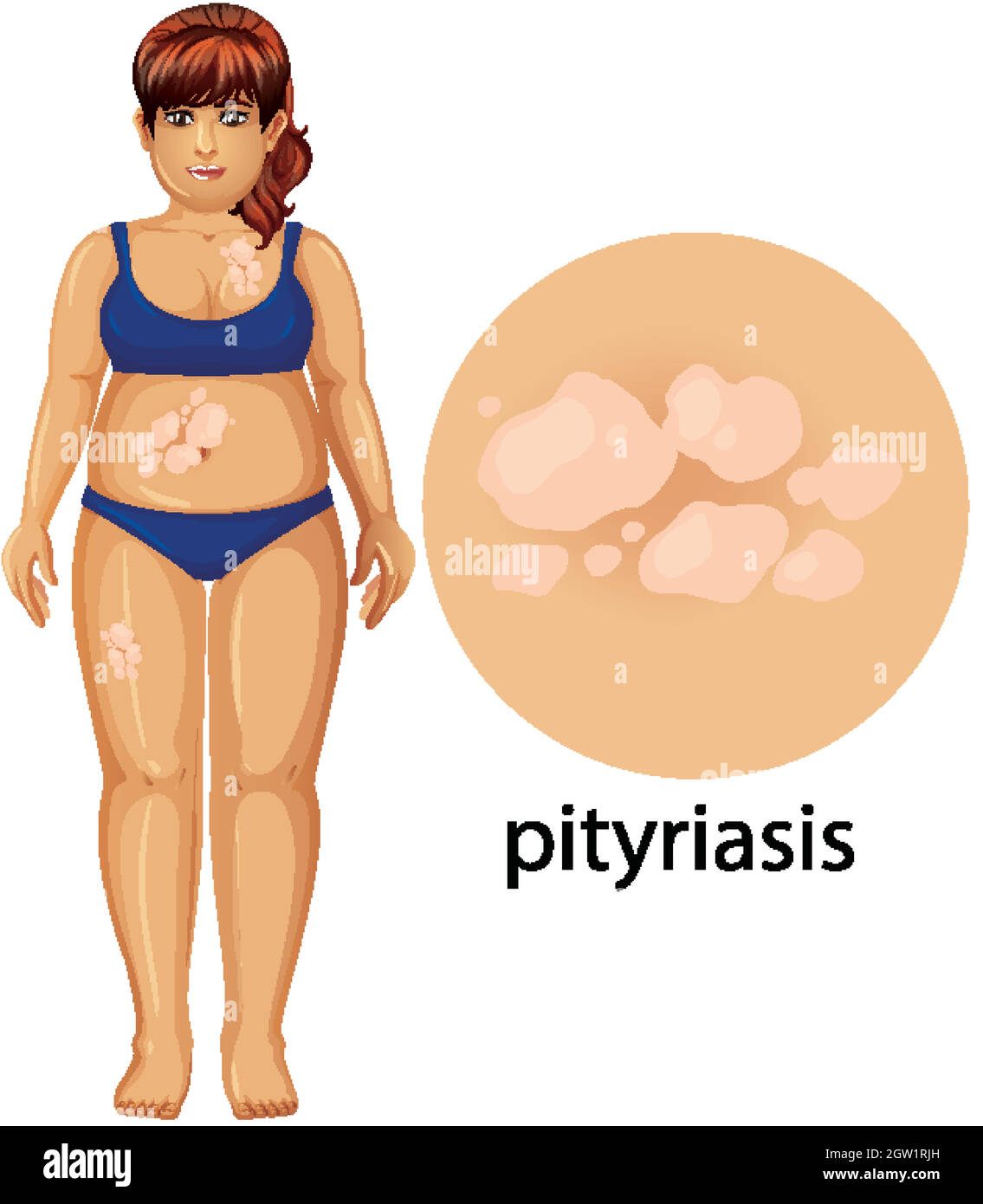 Femme avec pityriasis sur fond blanc Illustration de Vecteur