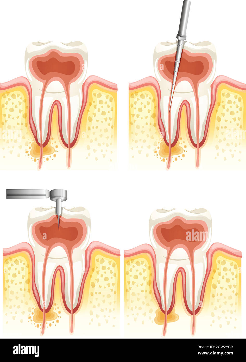 Canal racinaire dentaire Illustration de Vecteur