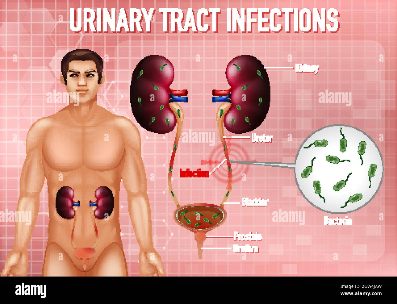 Illustration informative des infections des voies urinaires Illustration de Vecteur