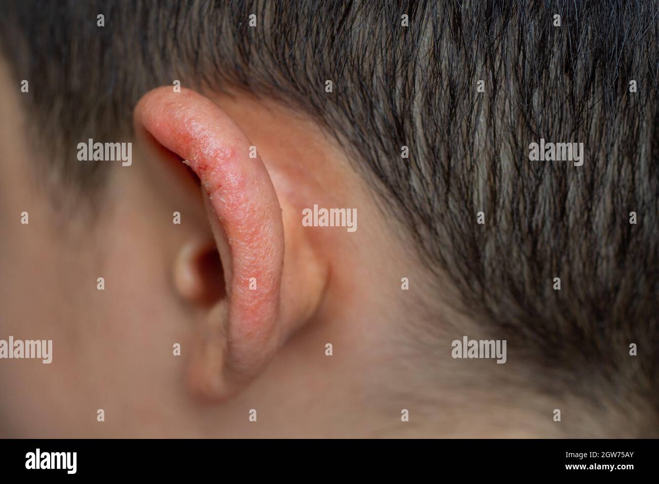 Fermez l'Auricule de l'enfant ou l'oreille externe avec la peau enflammée  de la dermatite atopique Photo Stock - Alamy