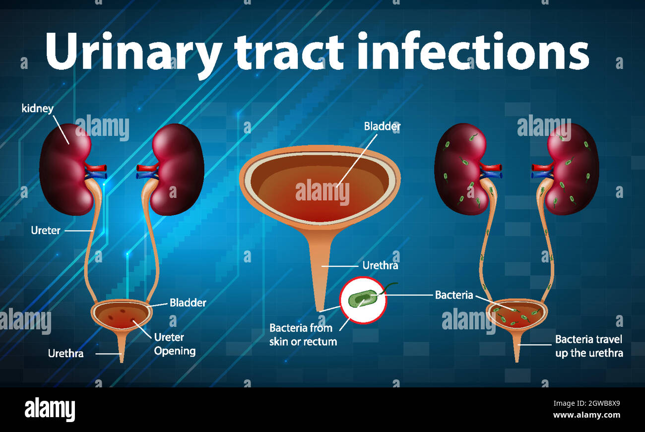 Illustration informative des infections des voies urinaires Illustration de Vecteur