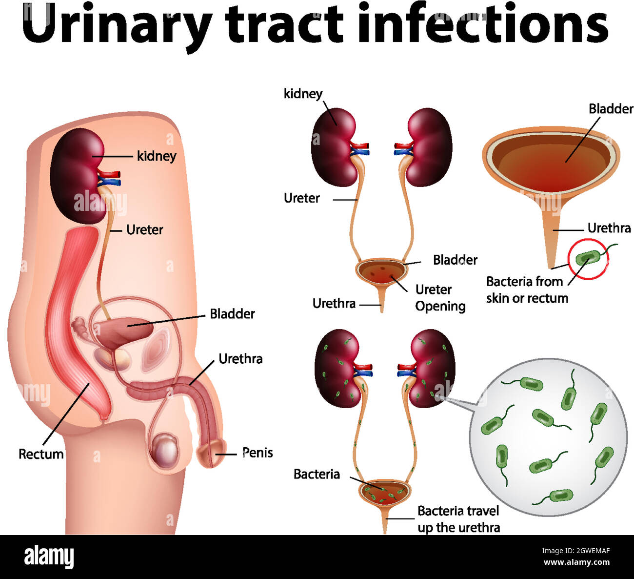 Illustration informative des infections des voies urinaires Illustration de Vecteur