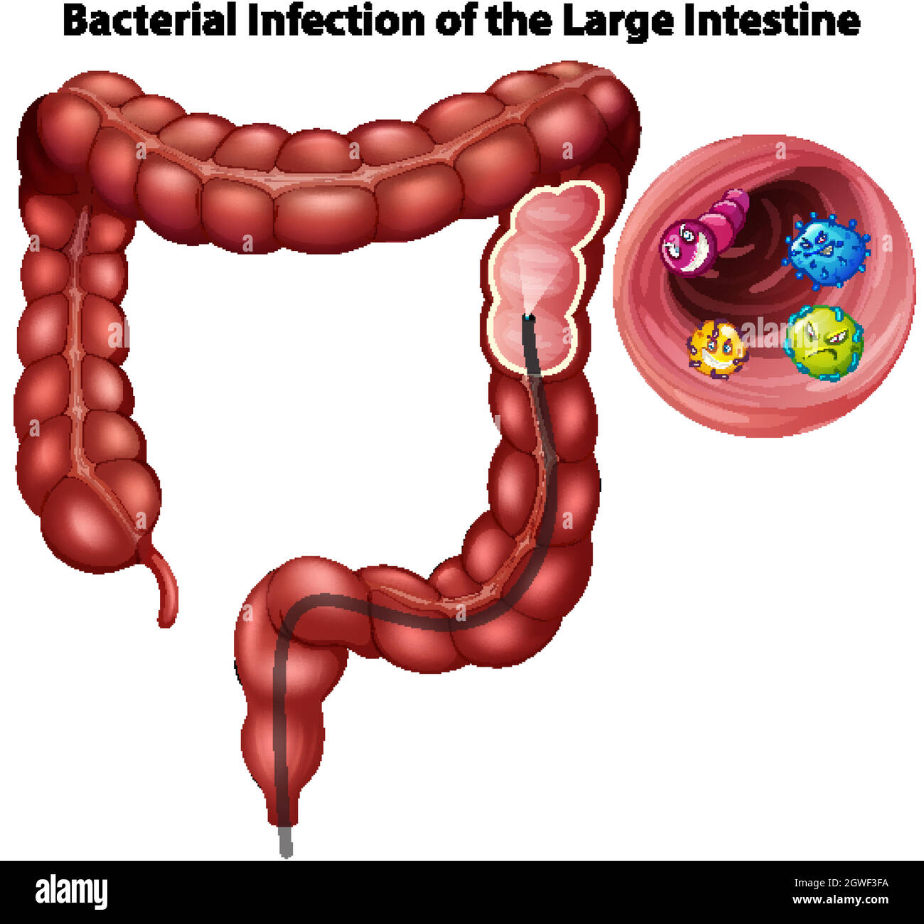 Infection bactérienne du gros intestin Illustration de Vecteur