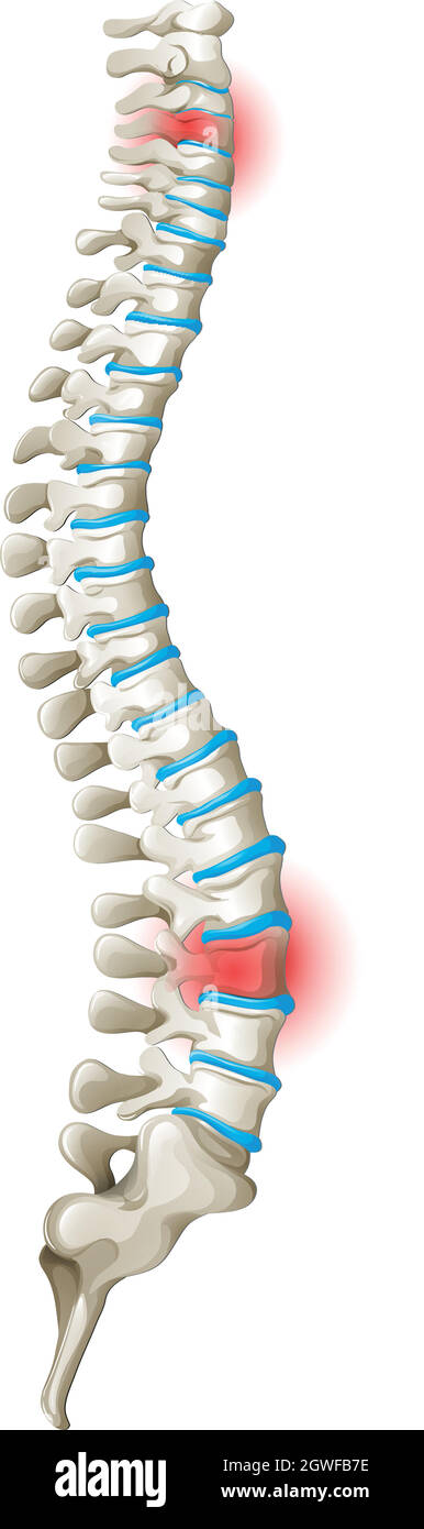 Schéma de la douleur dorsale de la colonne vertébrale Image Vectorielle  Stock - Alamy