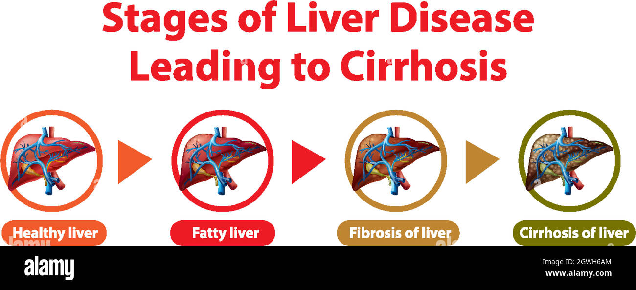 Stades de la maladie du foie menant à la cirrhose Illustration de Vecteur