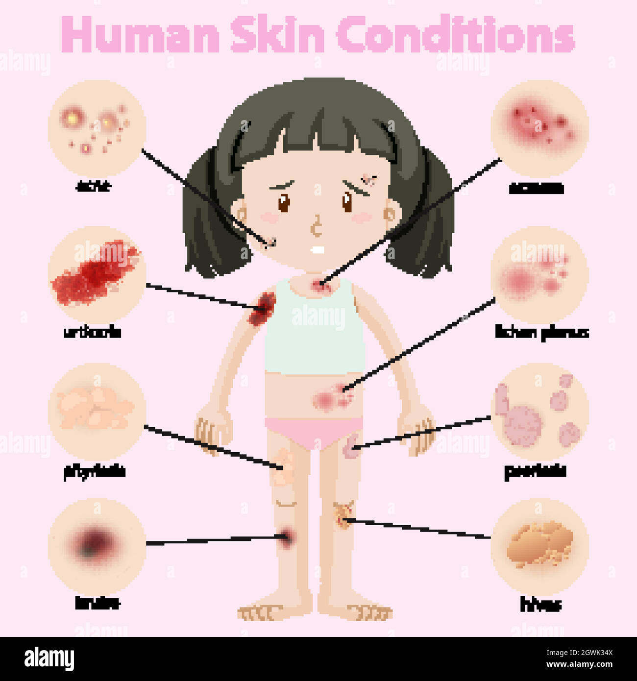 Schéma illustrant les conditions de la peau humaine Illustration de Vecteur