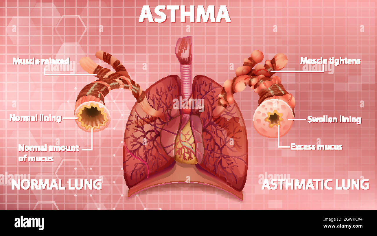 Comparaison des poumons sains et des poumons asthmatiques Illustration de Vecteur