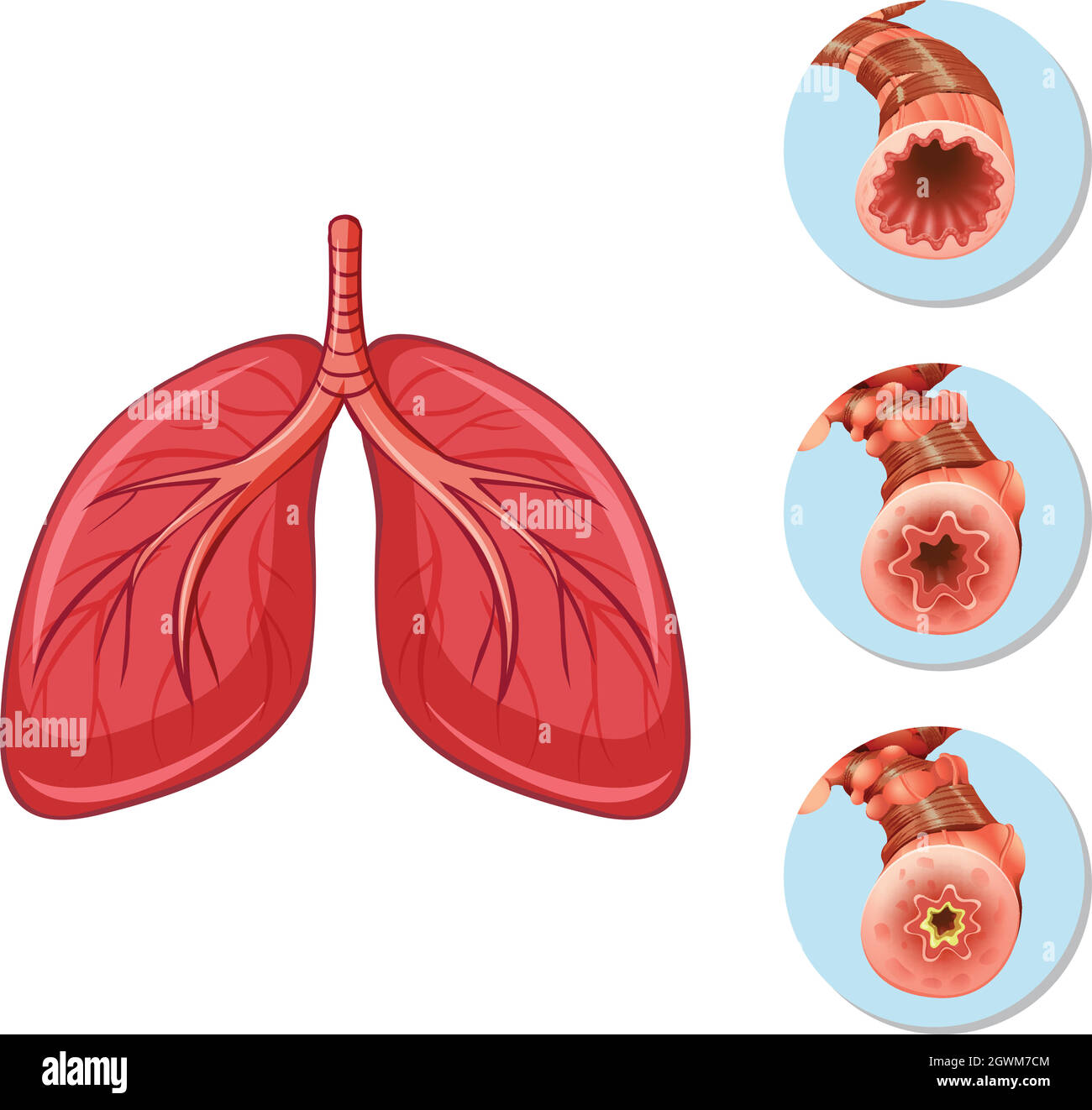 Étapes du bloc des voies aériennes vers les poumons Illustration de Vecteur