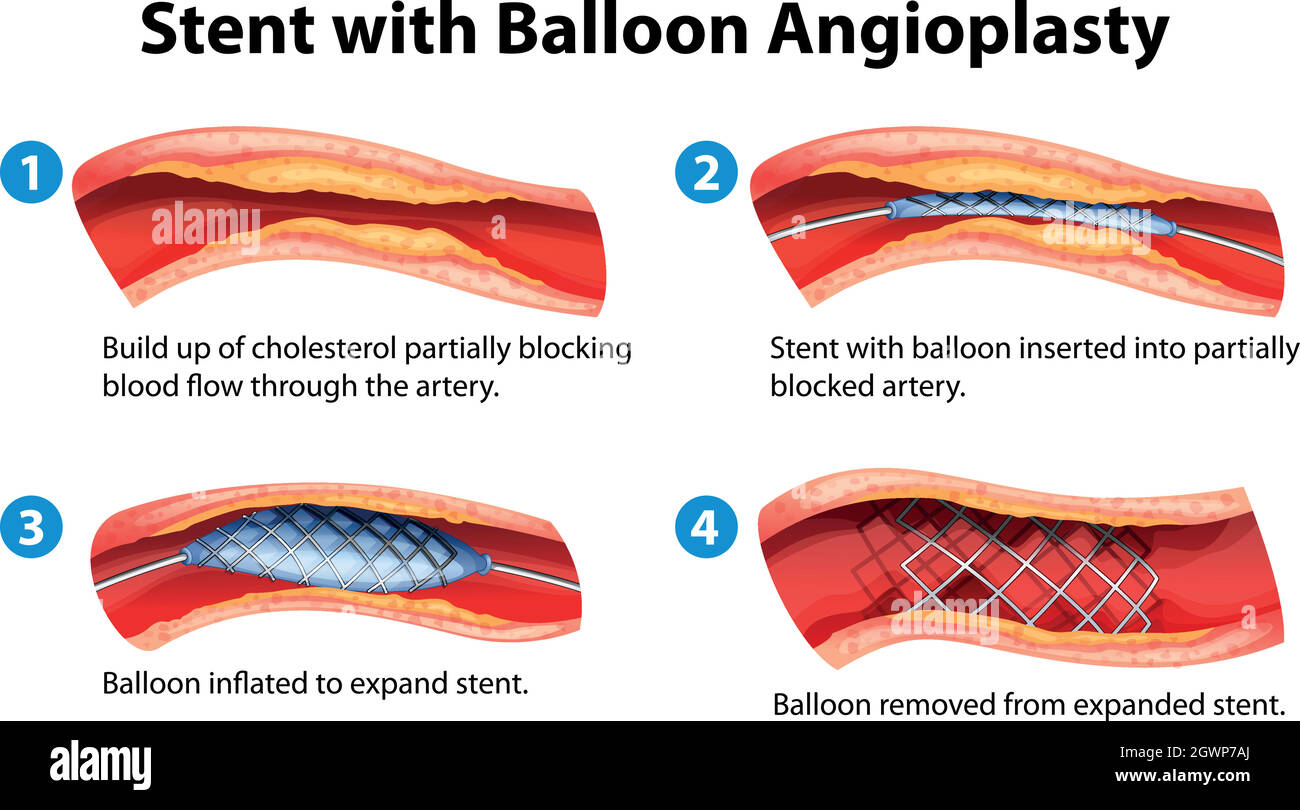 Procédure d'angioplastie du stent Illustration de Vecteur