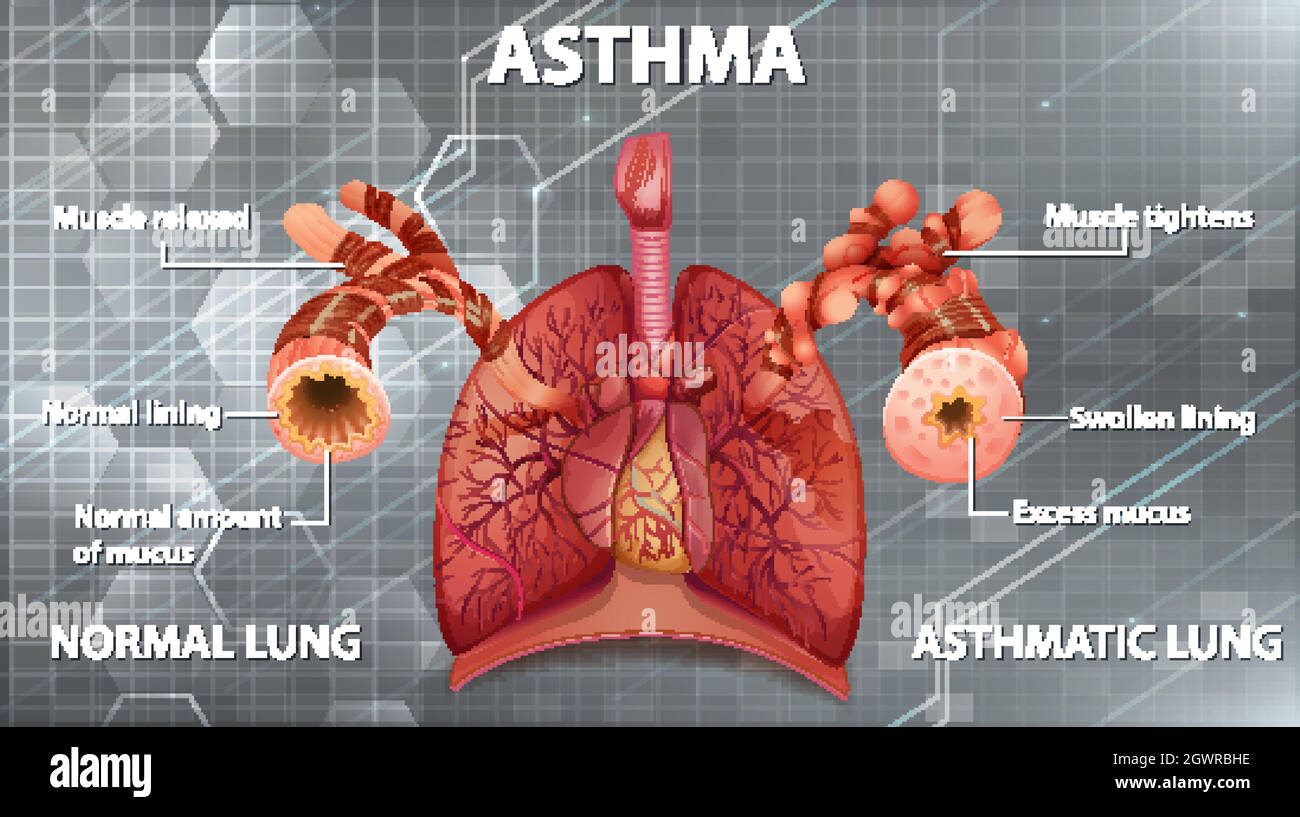 Comparaison des poumons sains et des poumons asthmatiques Illustration de Vecteur