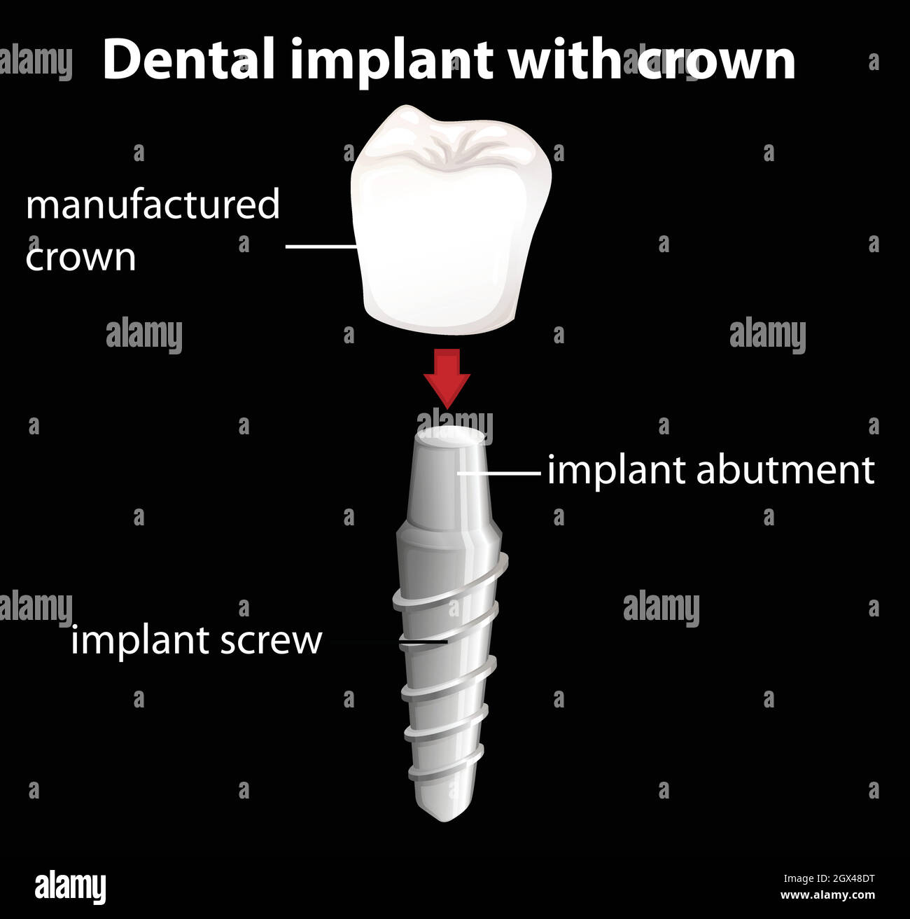 Un implant dentaire avec couronne Illustration de Vecteur