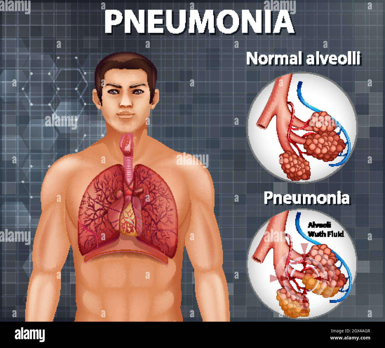 Comparaison d'alvéoles saines et de pneumonie Illustration de Vecteur