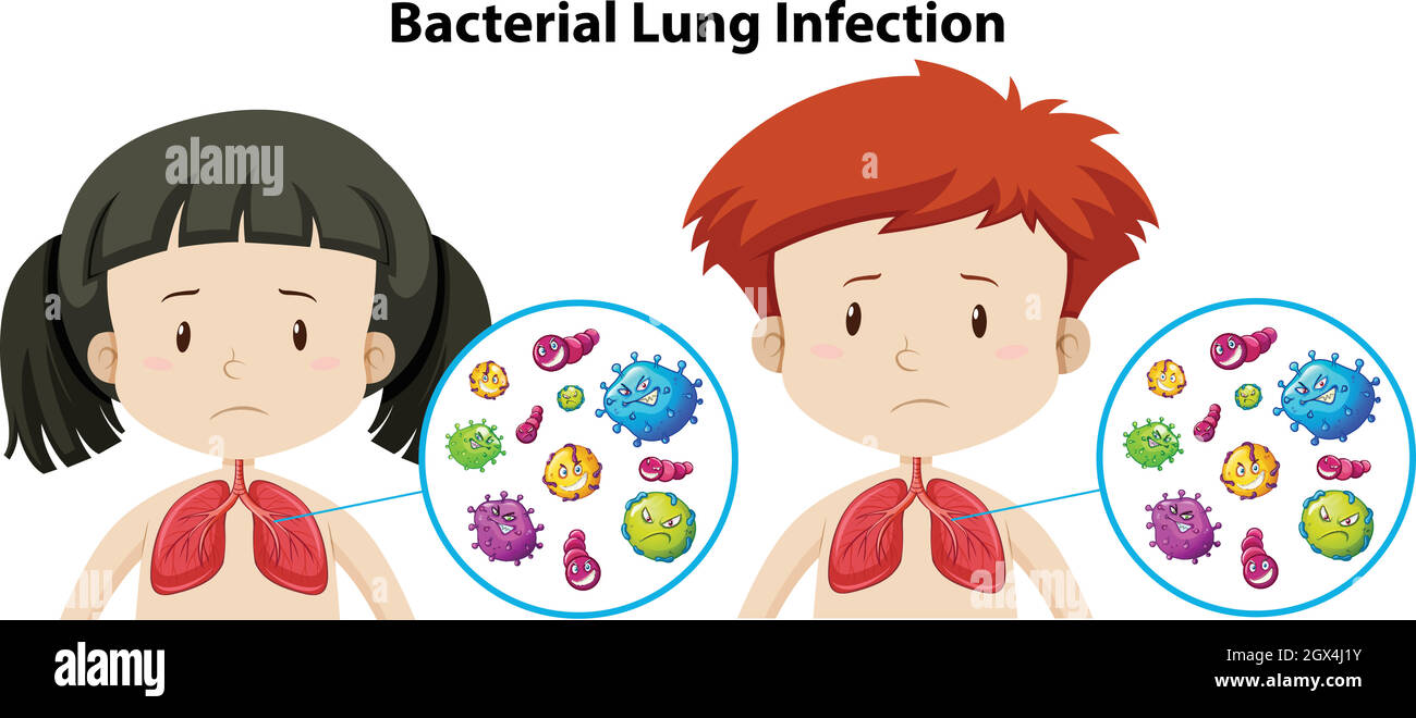 Un ensemble d'infection bactérienne de poumon Illustration de Vecteur