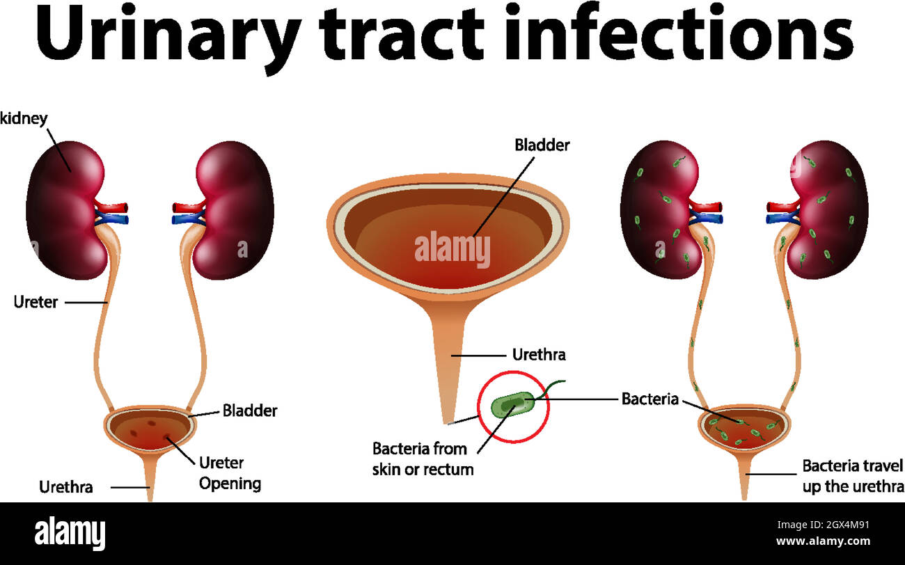 Illustration informative des infections des voies urinaires Illustration de Vecteur