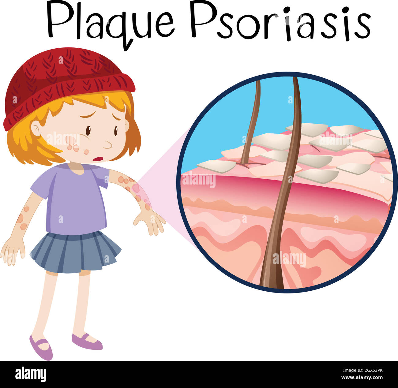 Anatomie humaine du psoriasis en plaques Illustration de Vecteur