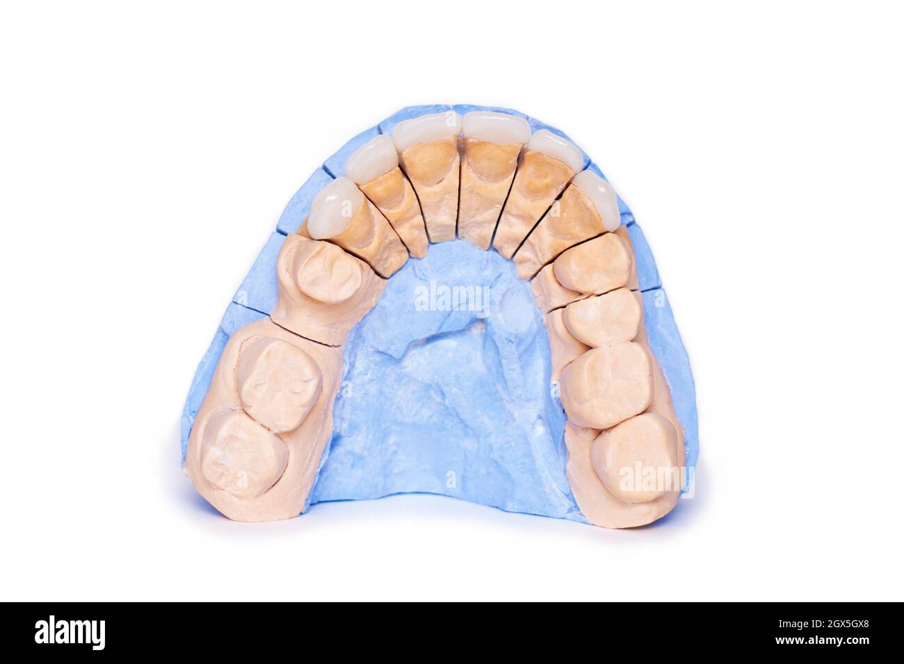 Boiseries et couronnes isolées sur fond blanc. Modèle de plâtre de dents. Modèle de plâtre à mâchoire inférieure avec dents préparées. Plâtre démontable de travail Banque D'Images