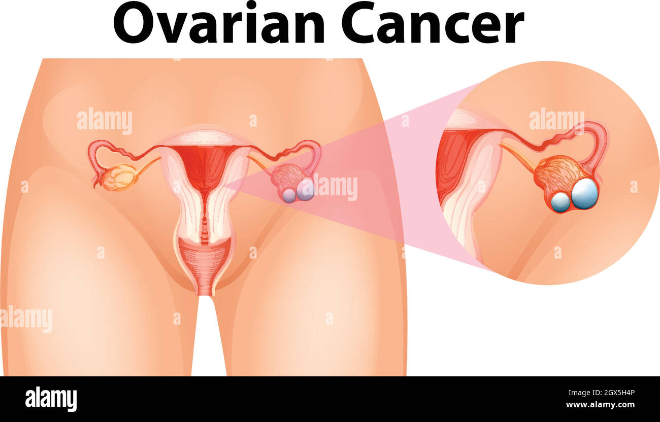 Schéma montrant le cancer de l'ovaire Illustration de Vecteur
