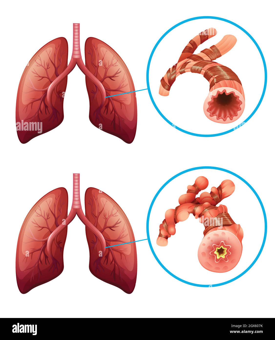 Diagramme montrant les poumons atteints de maladie Illustration de Vecteur