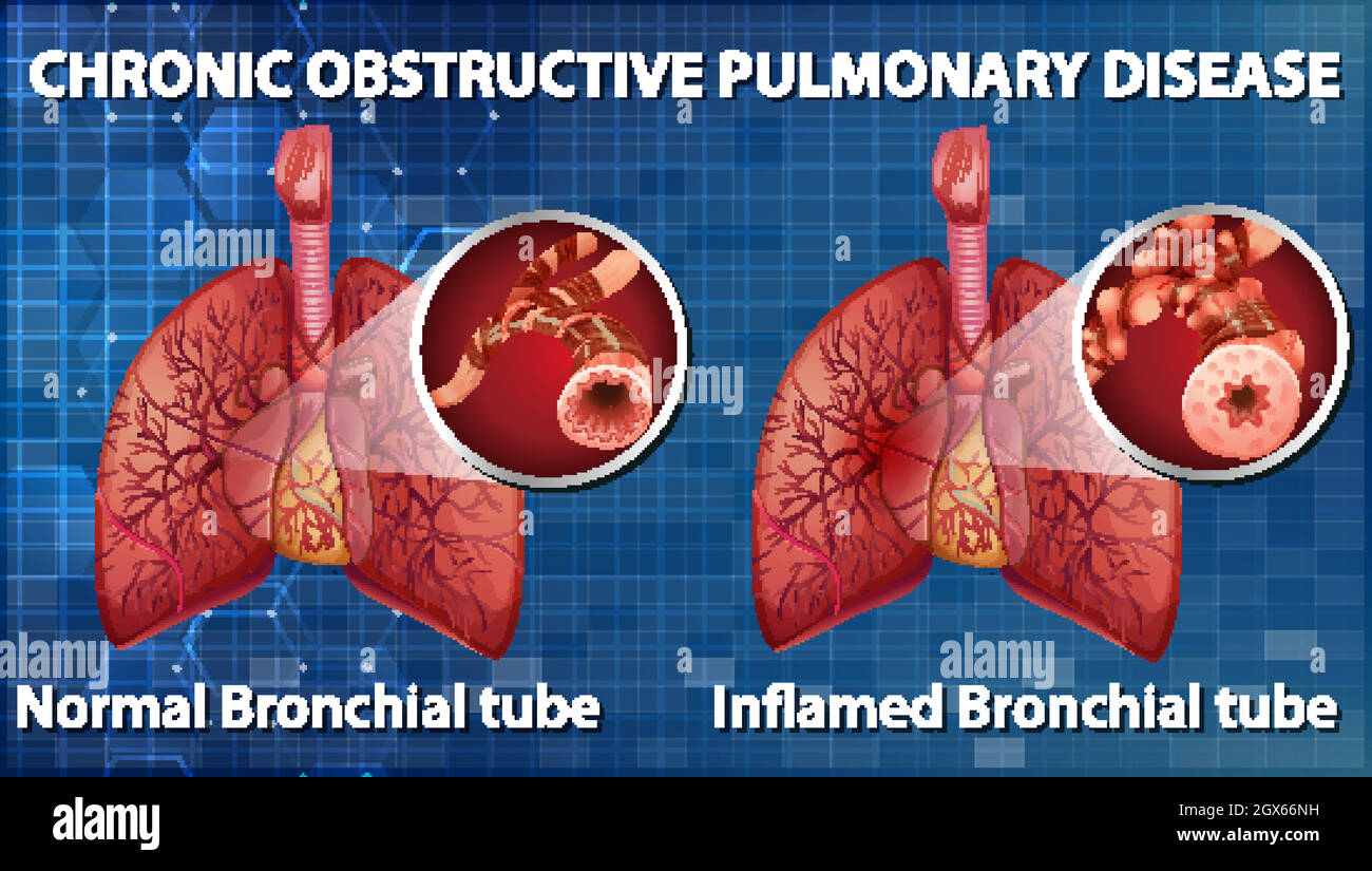 La maladie pulmonaire obstructive chronique Illustration de Vecteur