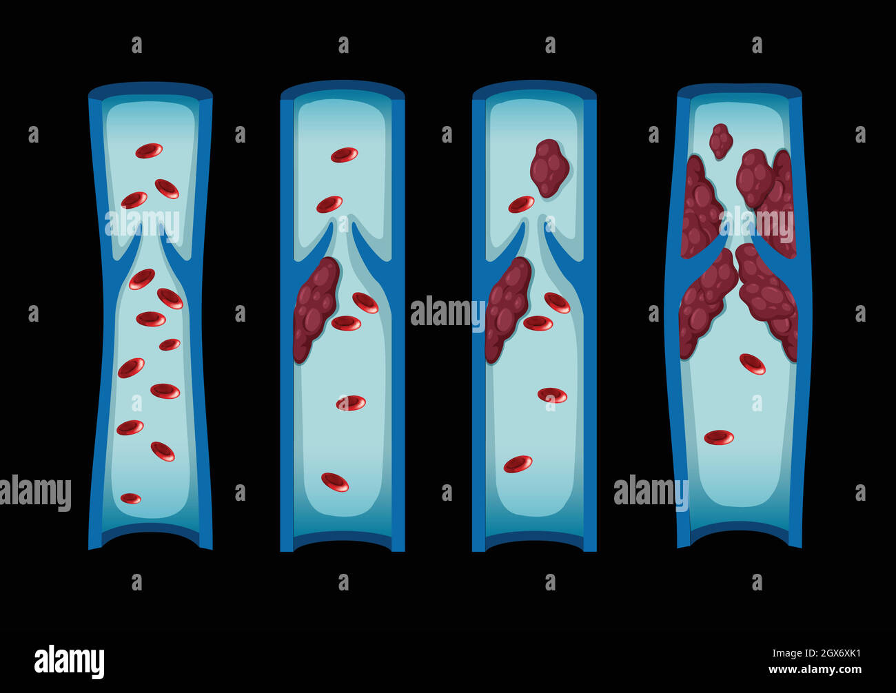 Différents stades de caillot de sang chez l'homme Illustration de Vecteur