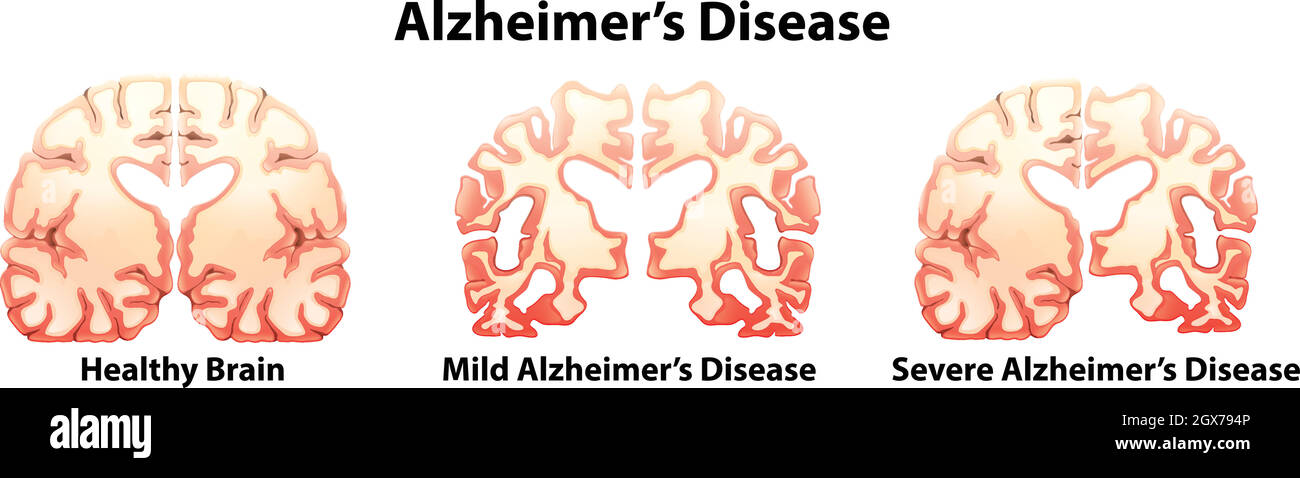 La maladie d'Alzheimer Illustration de Vecteur