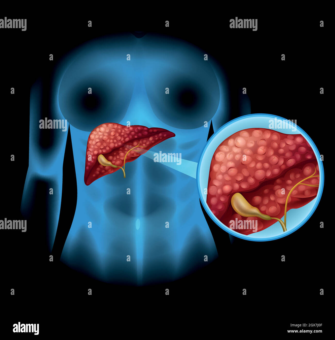 Diagramme de la sclérose en plaques en détail Illustration de Vecteur