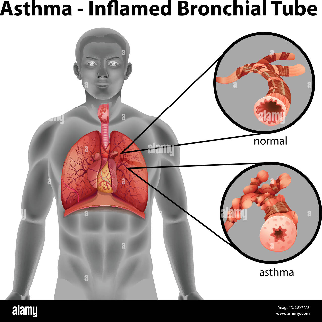 Tube bronchique à inflammation d'asthme Illustration de Vecteur