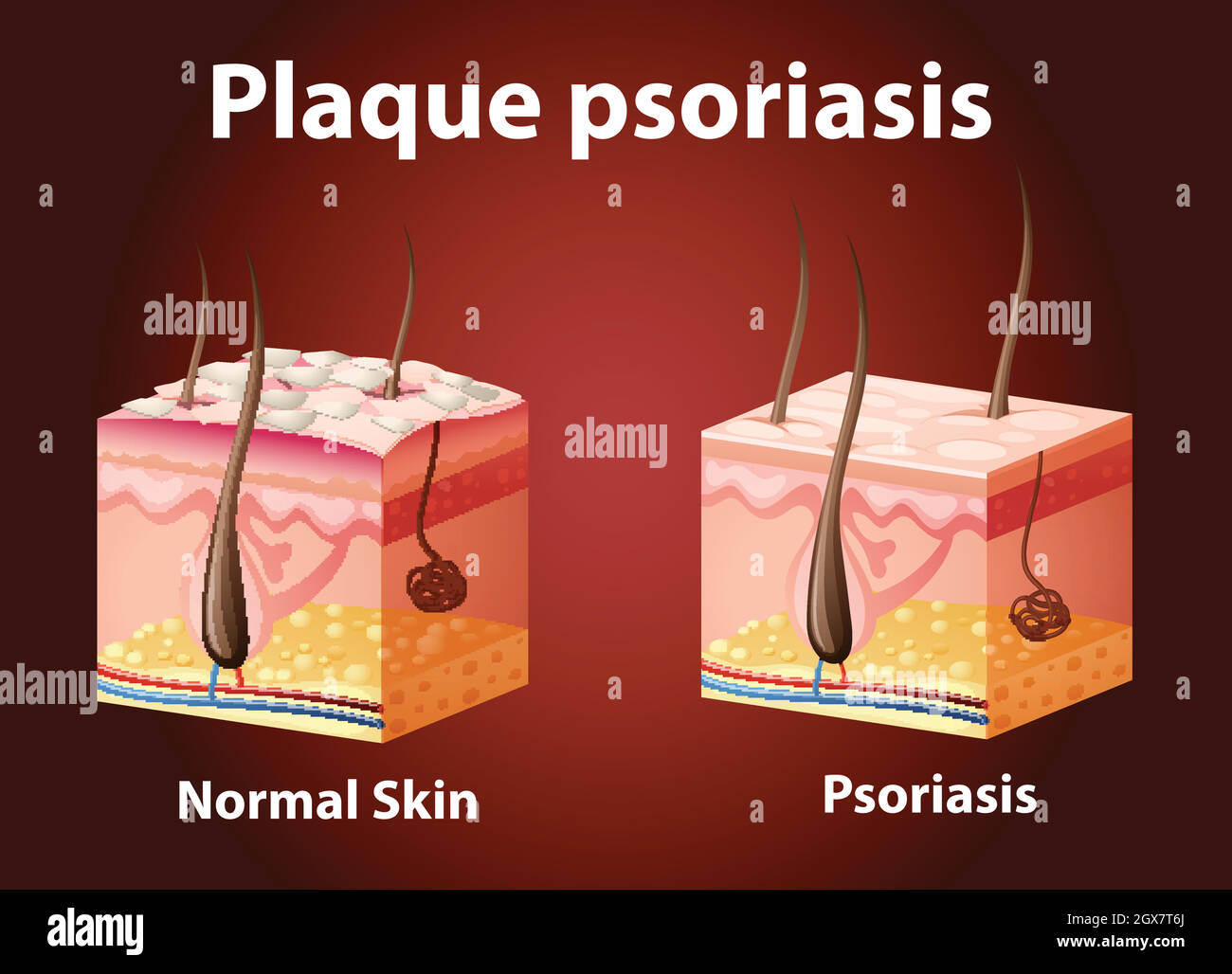 Schéma montrant le psoriasis en plaques Illustration de Vecteur