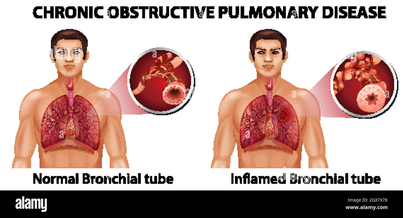 La maladie pulmonaire obstructive chronique Illustration de Vecteur