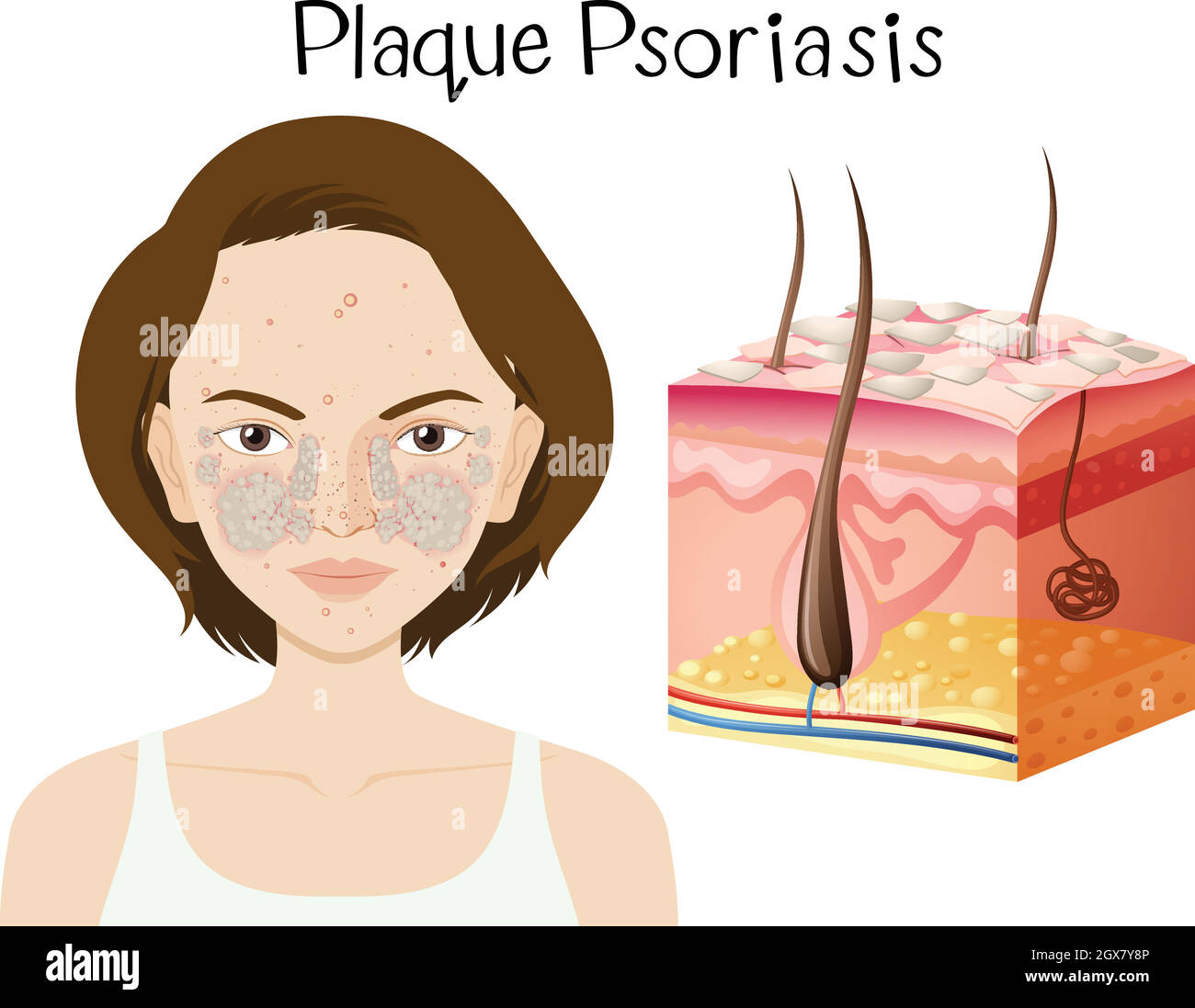 Anatomie humaine du psoriasis en plaques Image Vectorielle Stock Alamy